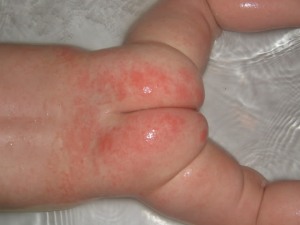 Causes of Buttock rash - RightDiagnosis.com